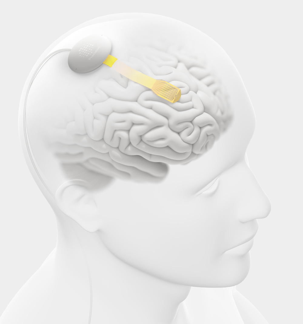 Precision Neuroscience System
