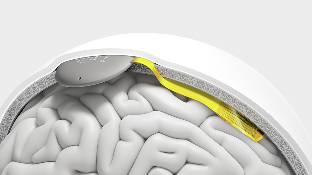Precision Neuroscience System, Cortical Interface and Subgaleal Implant